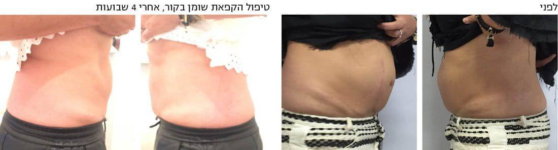 הקפאת שומן בקור הקפאת שומן בקור