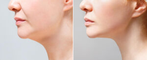 close portrait aged woman before after facial rejuvenation procedure correction chin shape liposuction neck result procedure clinic aesthetic medicine