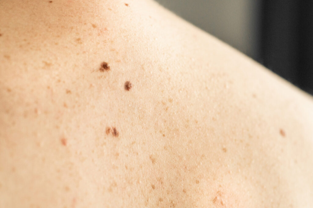 close-up-detail-bare-skin-man-back-with-scattered-moles-freckles-checking-benign-moles (1) כתמים בגוף ופיגמנטציה
