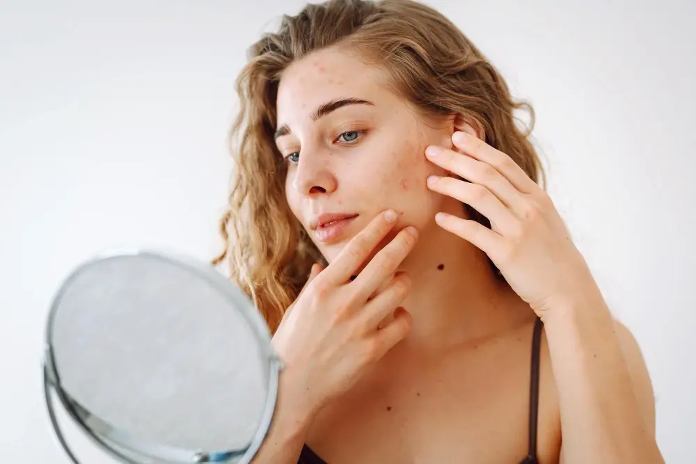 1753263096_465401_97664-1000×1000 הלגה רקנטי טיפולים קוסמטיים ויופי - HELGA REKANATI|כך תטפלי באקנה – בלי לייבש את העור ובלי לפגוע בו